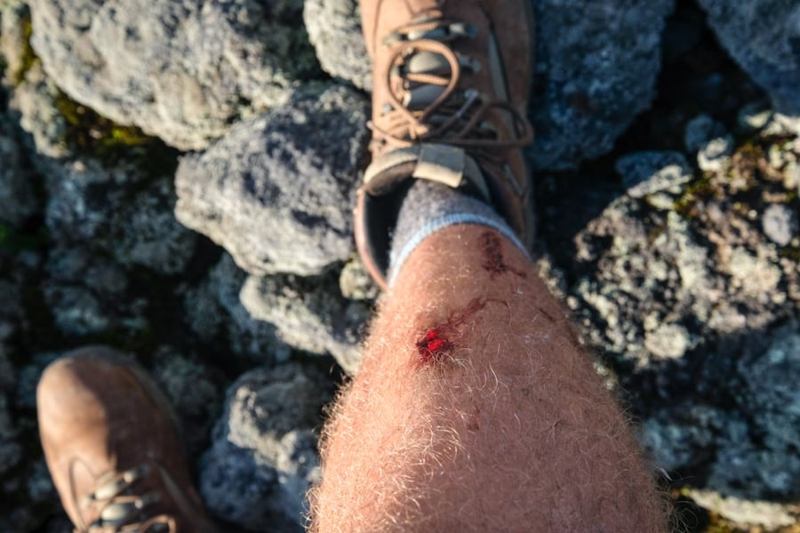 Bloody scraped legs from hiking